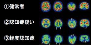 刺さない鍼を使って 認知症を予防 治療 しおさき鍼灸施術所